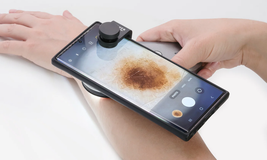 Skin mole examination using ILLUCO dermatoscope for clinical diagnosis
